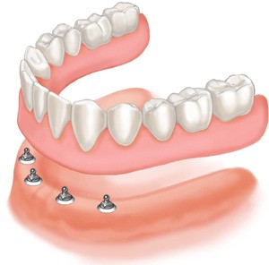 Denture supported by mini dental implants