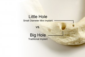 Mini Implant vs Traditional Implant